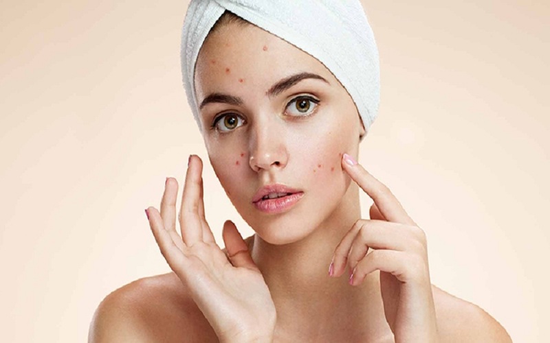 Treat Acne at Home with Products from Your Kitchen 